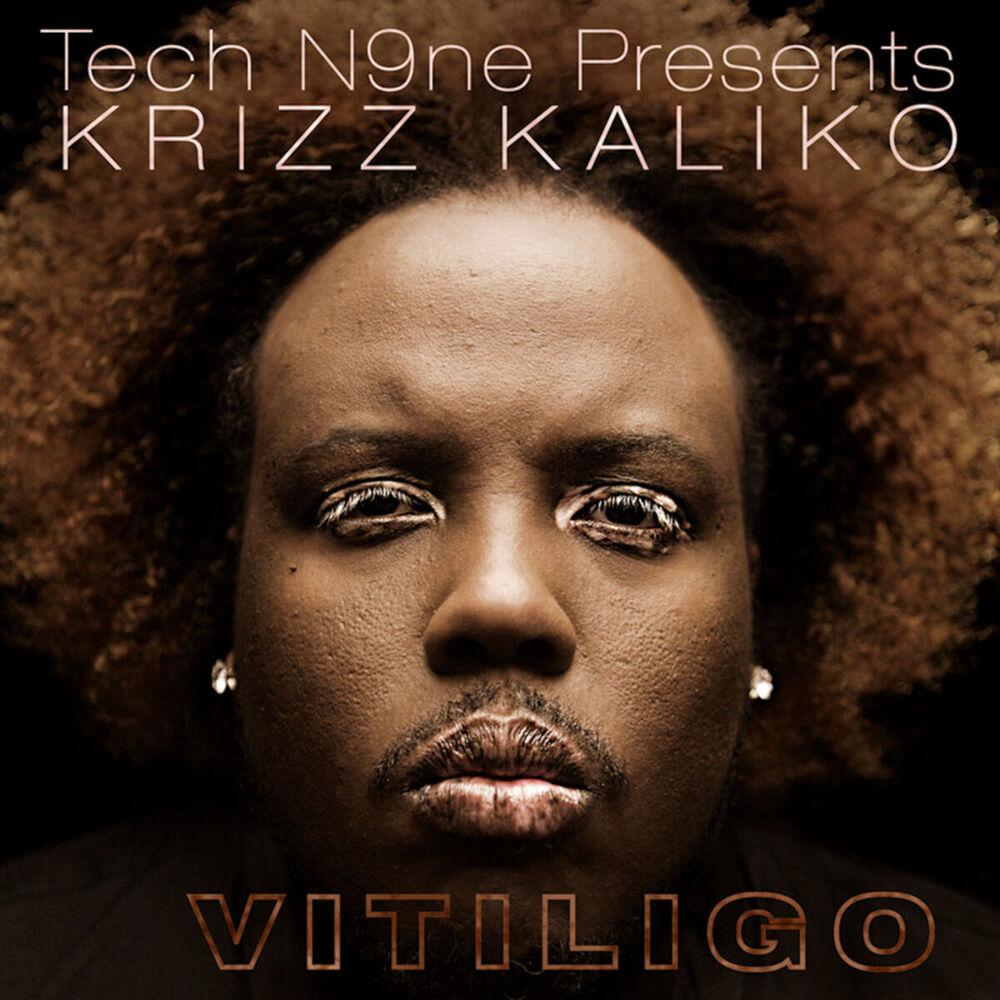 Picture of Vitiligo