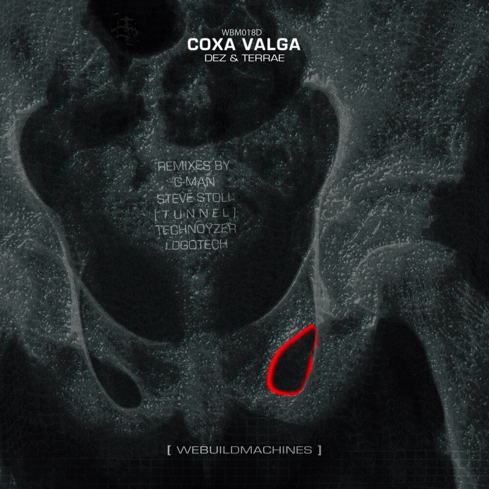 Picture of Coxa Valga