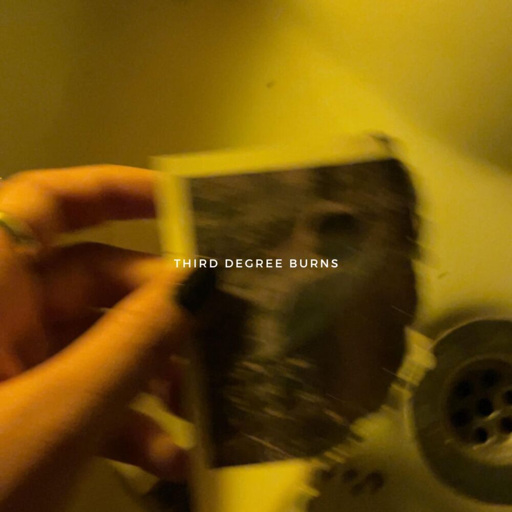 Picture of Third Degree Burns