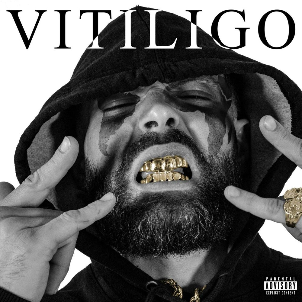Picture of Vitiligo