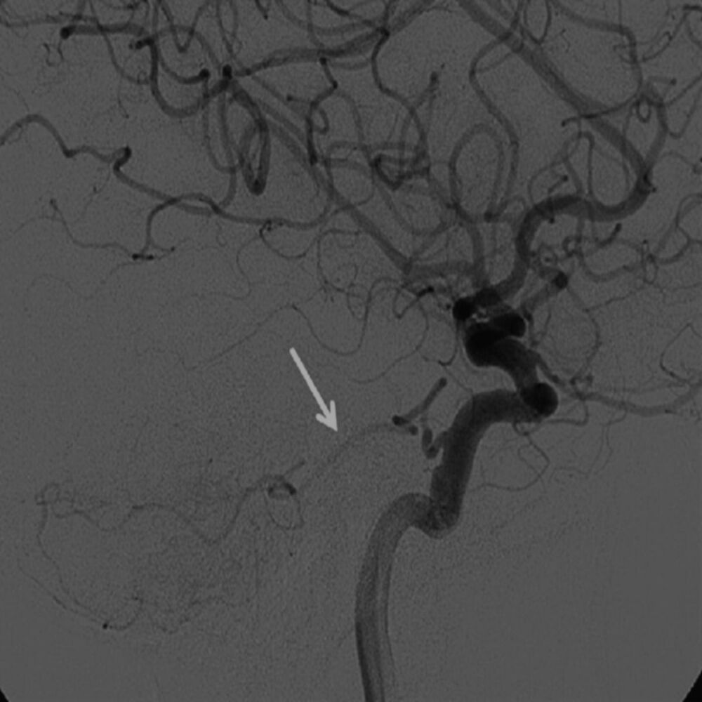 Picture of Subarachnoid Haemorrhage