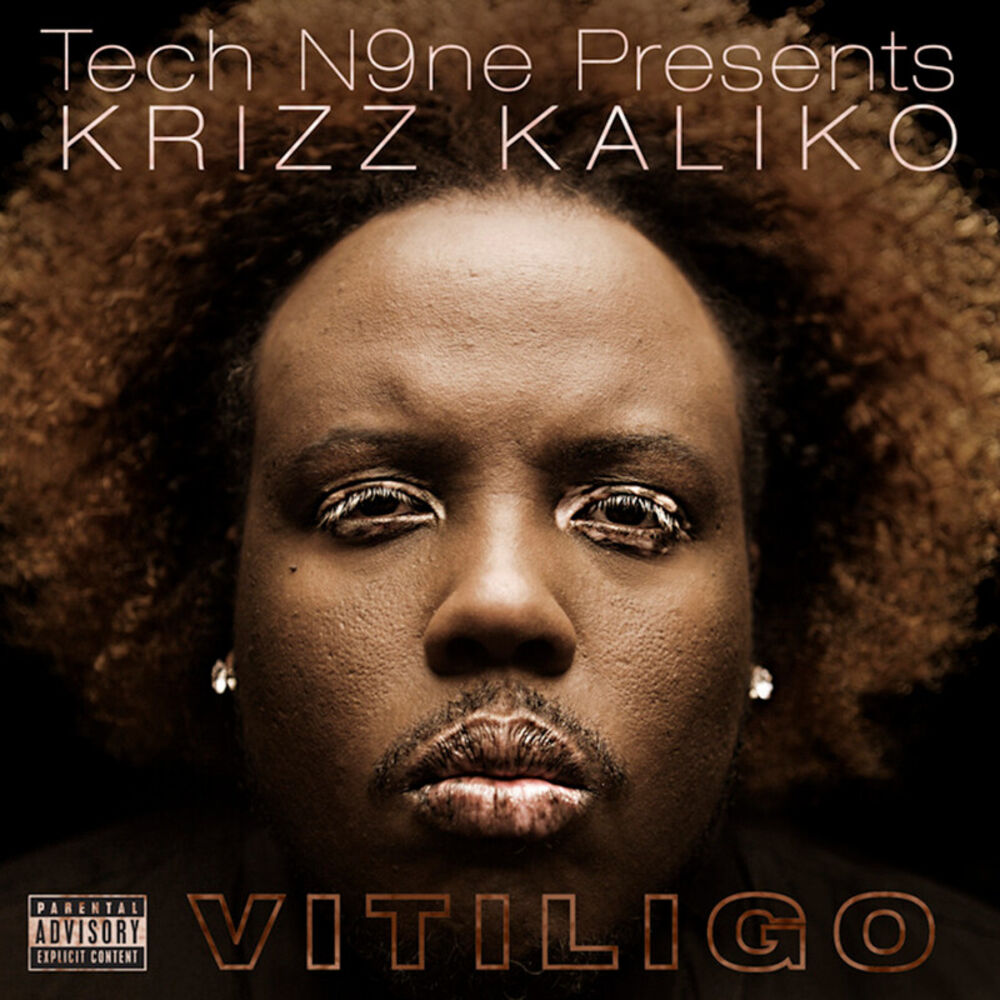 Picture of Vitiligo
